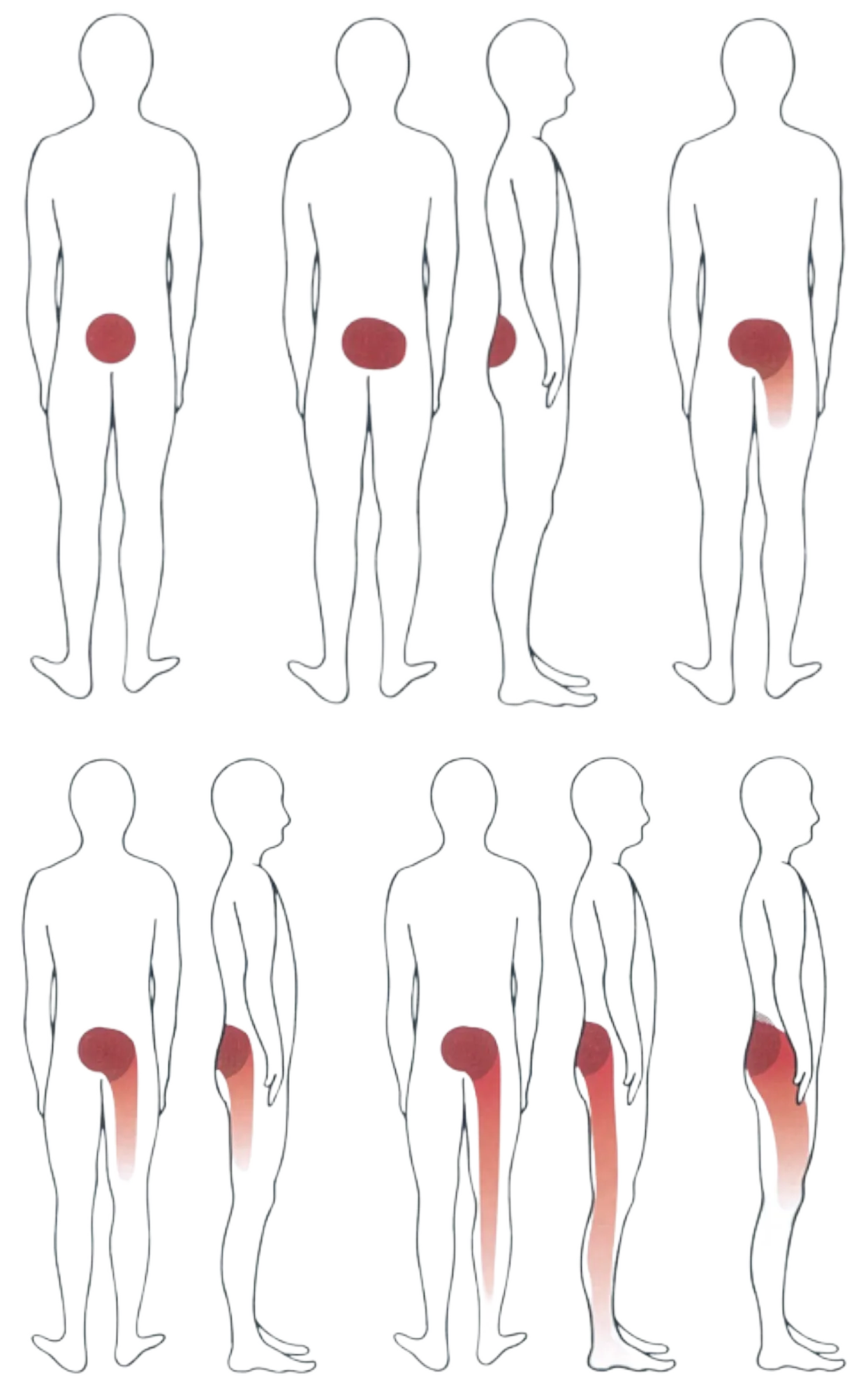 Diagram of how lower-back pain spreads from the spine down the leg as it worsens